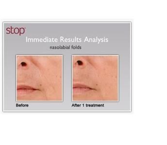 New Tripollar STOP   Anti Aging Face Skin Care Renewal  